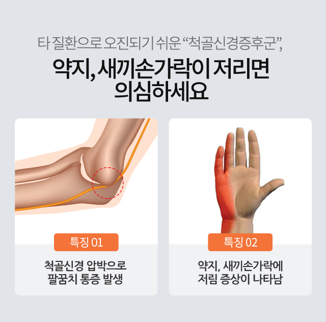 특징1 척골신경 압박으로 팔꿈치 통증 발생/ 특징2 약지, 새끼손가락에 저림 증상이 나타남